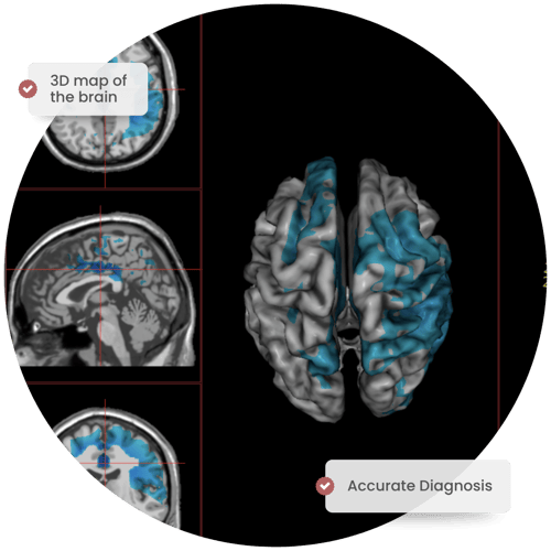 3D qEEG brain map at Vital Brain Health